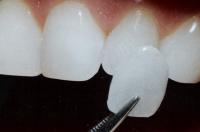 Какие существуют варианты восстановления внешнего вида зубов
