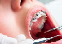 Встановлення брекетів у Житомирі в стоматології доктора Колоса